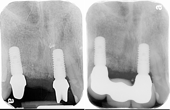 Ridge Augmentation Bellevue WA | After Tooth Extraction