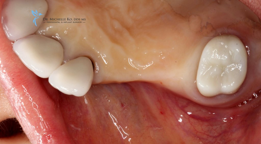 Tooth Extraction Ridge Ridge Augmentation Bellevue WA | After Tooth Extraction